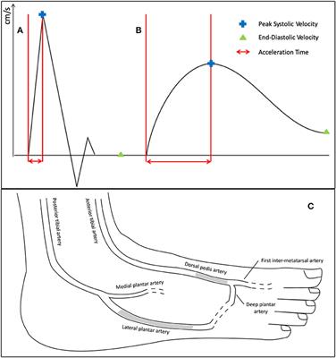 Accuracy of Acceleration Time of Distal Arteries to Diagnose Severe Peripheral Arterial Disease